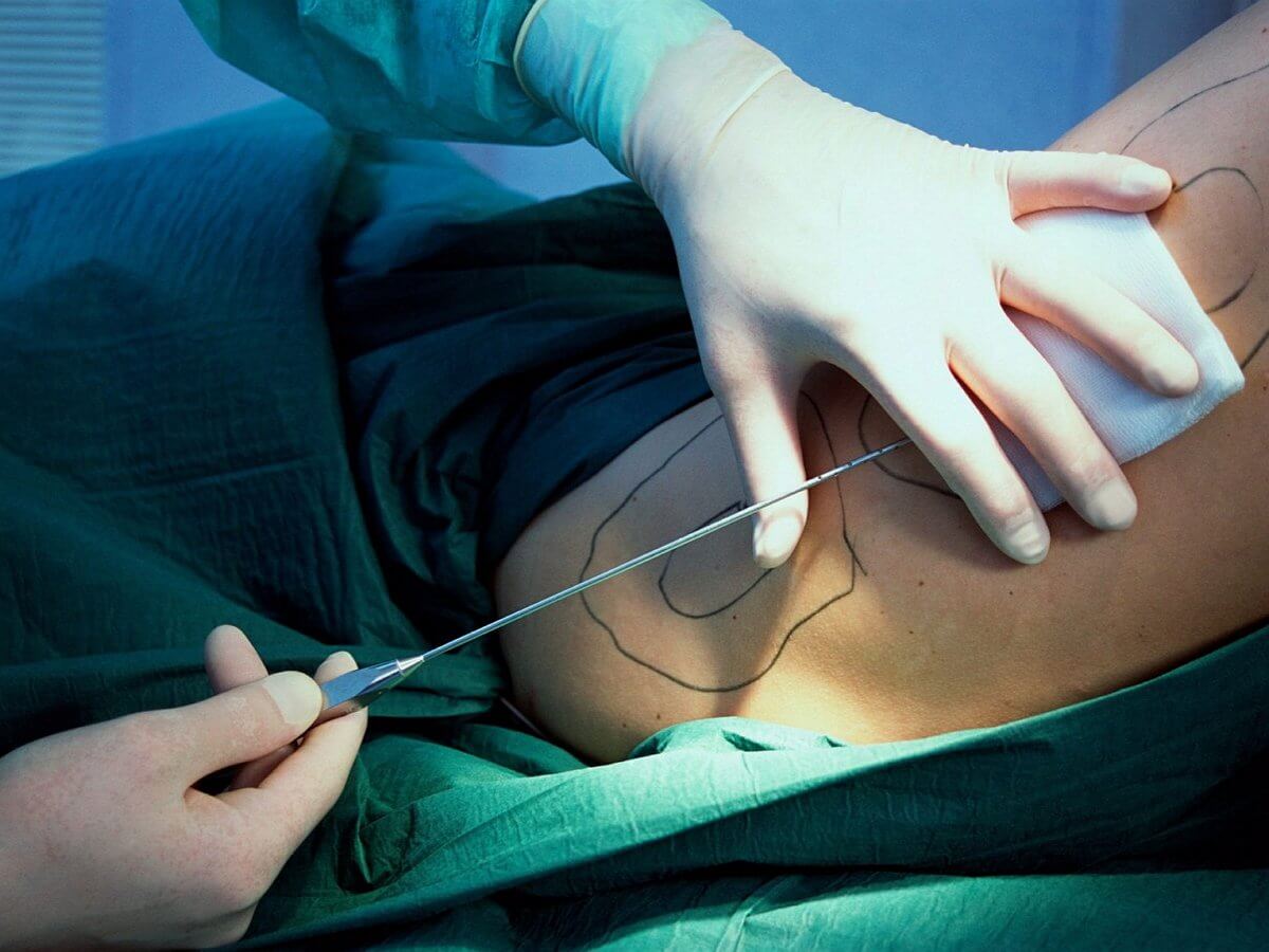 Во время липосакции хирург выступает в&nbsp;роли скульптора вашего тела