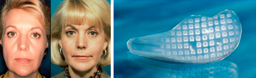 Так выглядит силиконовый имплант скул