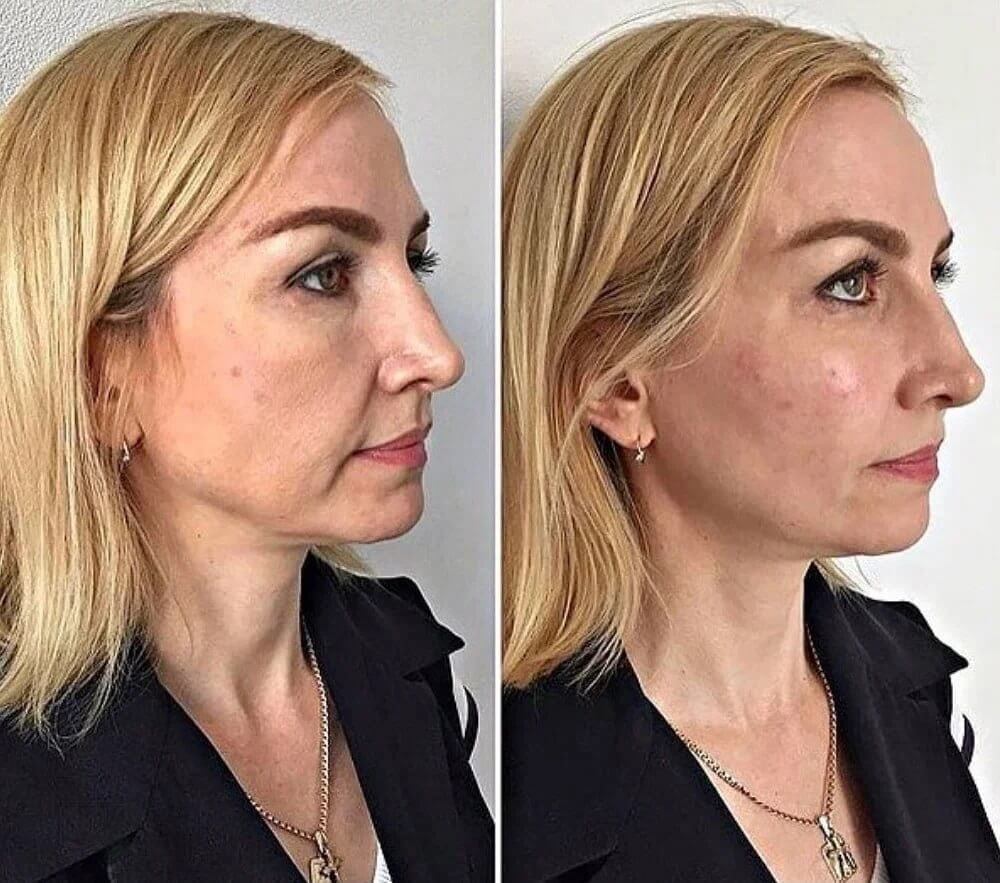 Филлеры в скулы отлично меняют внешность, но результат их применения временный