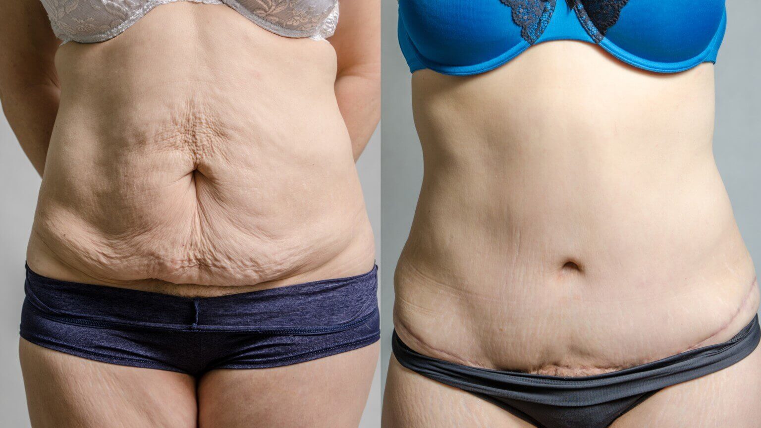 Абдоминопластика не помогает похудеть, но формирует красивые очертания фигуры
