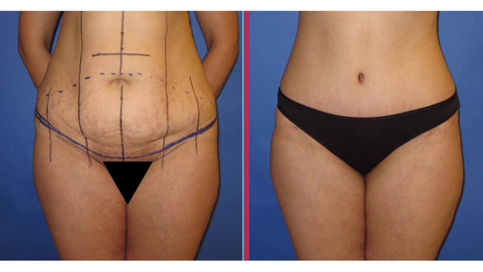 Порядок проведения процедуры всегда определяется индивидуально с учетом особенностей фигуры пациента