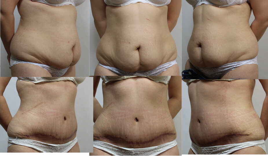 Рубцы после абдоминопластики действительно образуются, но в большинстве случаев со временем становятся незаметными