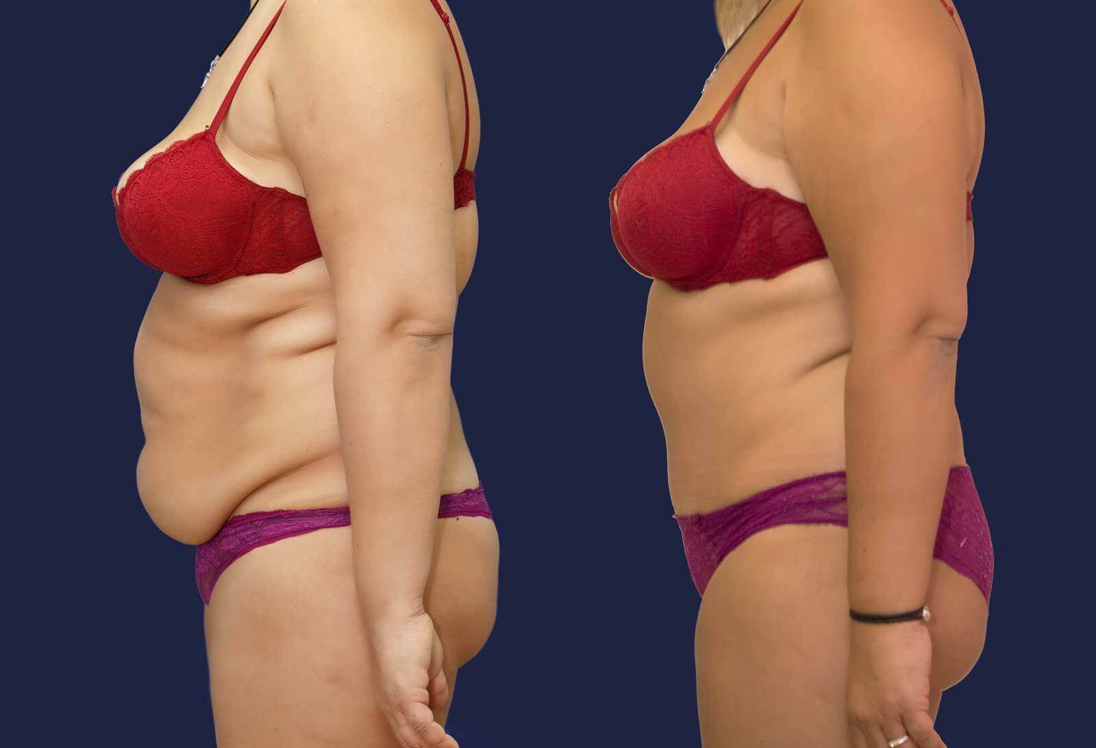 Пластика живота – до и после процедуры