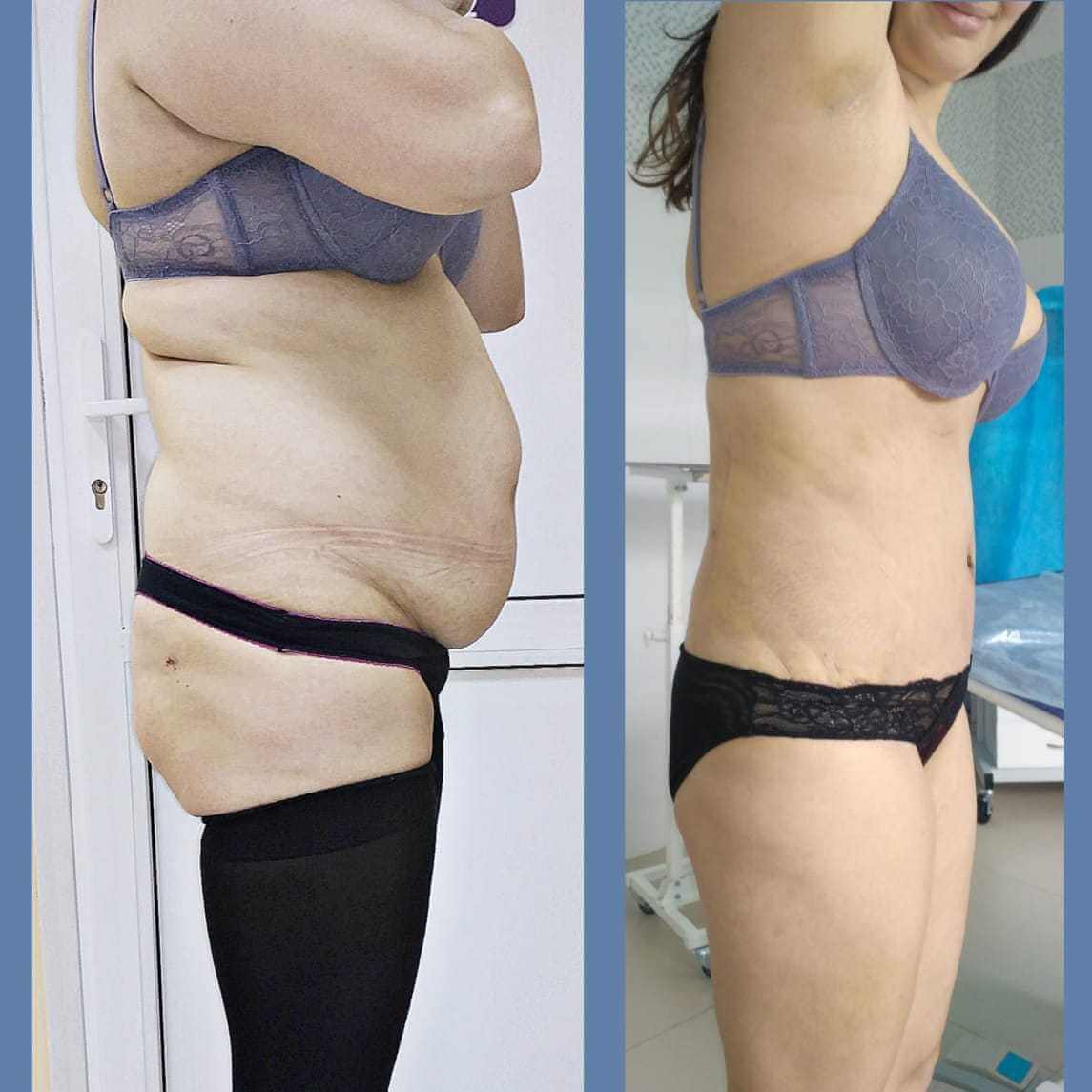Эффект от абдоминопластики потрясающий. Особенно в сочетании с последующей диетой