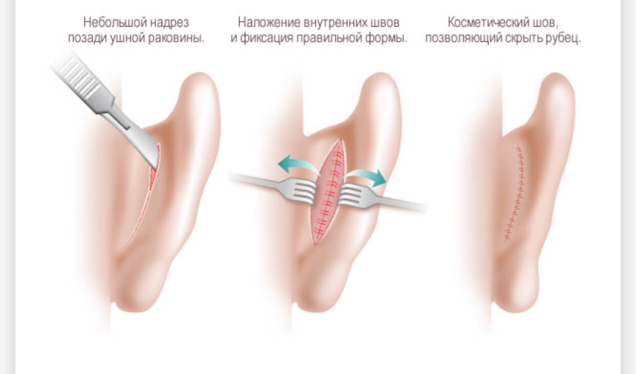 Порядок выполнения пластики ушей