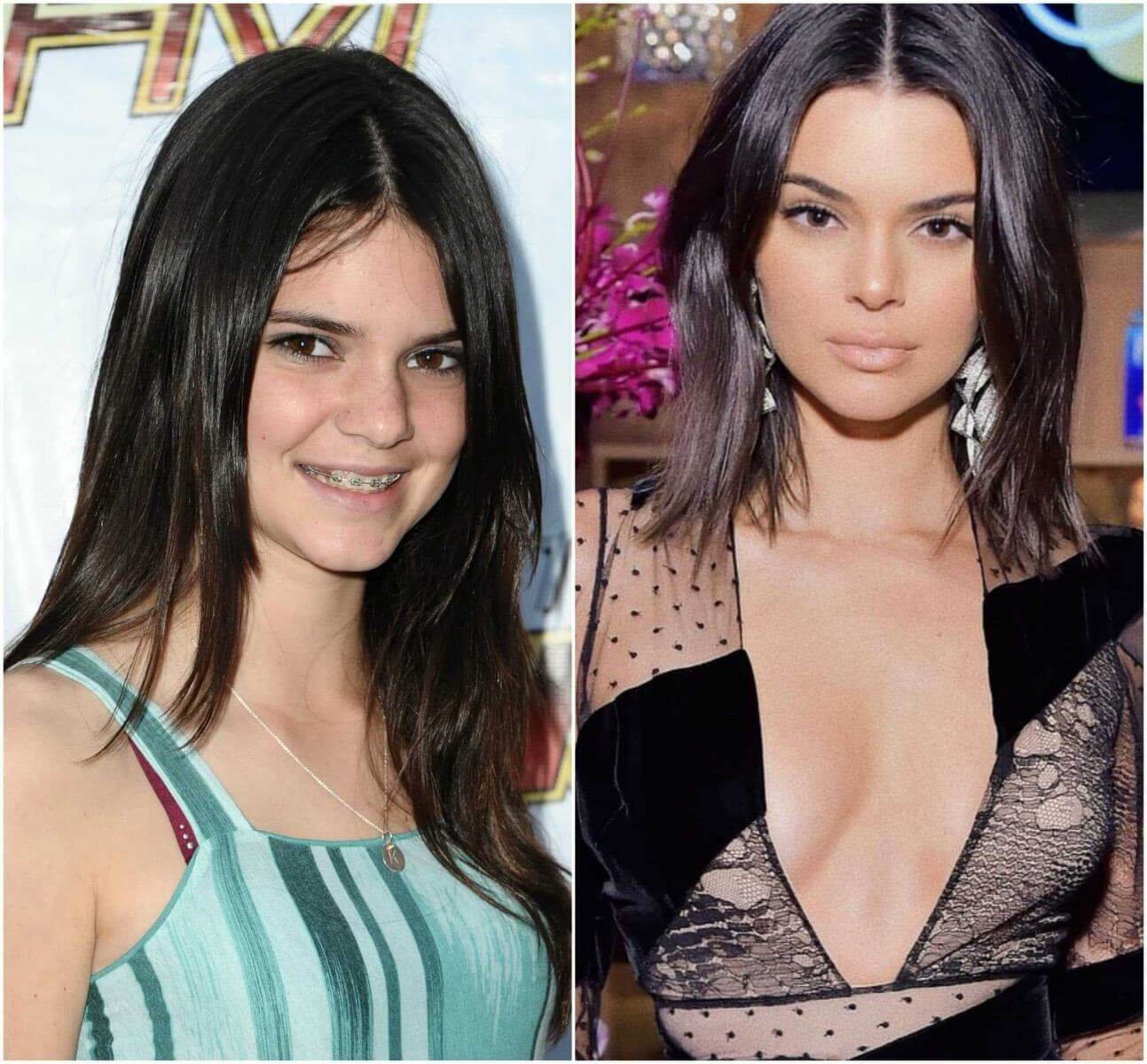 Кендалл Дженнер до&nbsp;и&nbsp;после пластики