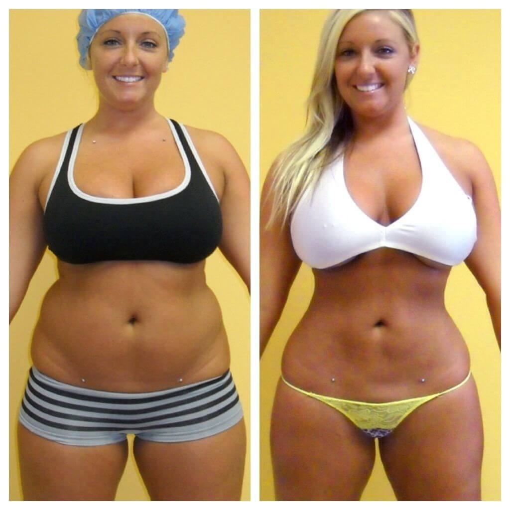 Mommy makeover &ndash; до&nbsp;и&nbsp;после