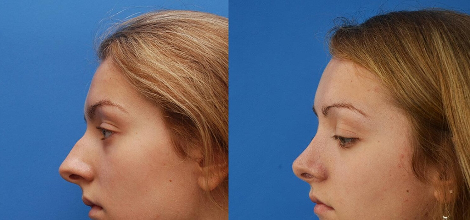 Грамотно проведенная ринопластика кардинально меняет внешность в лучшую сторону