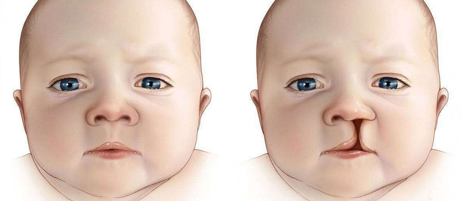 Расщелина губы – заячья губа