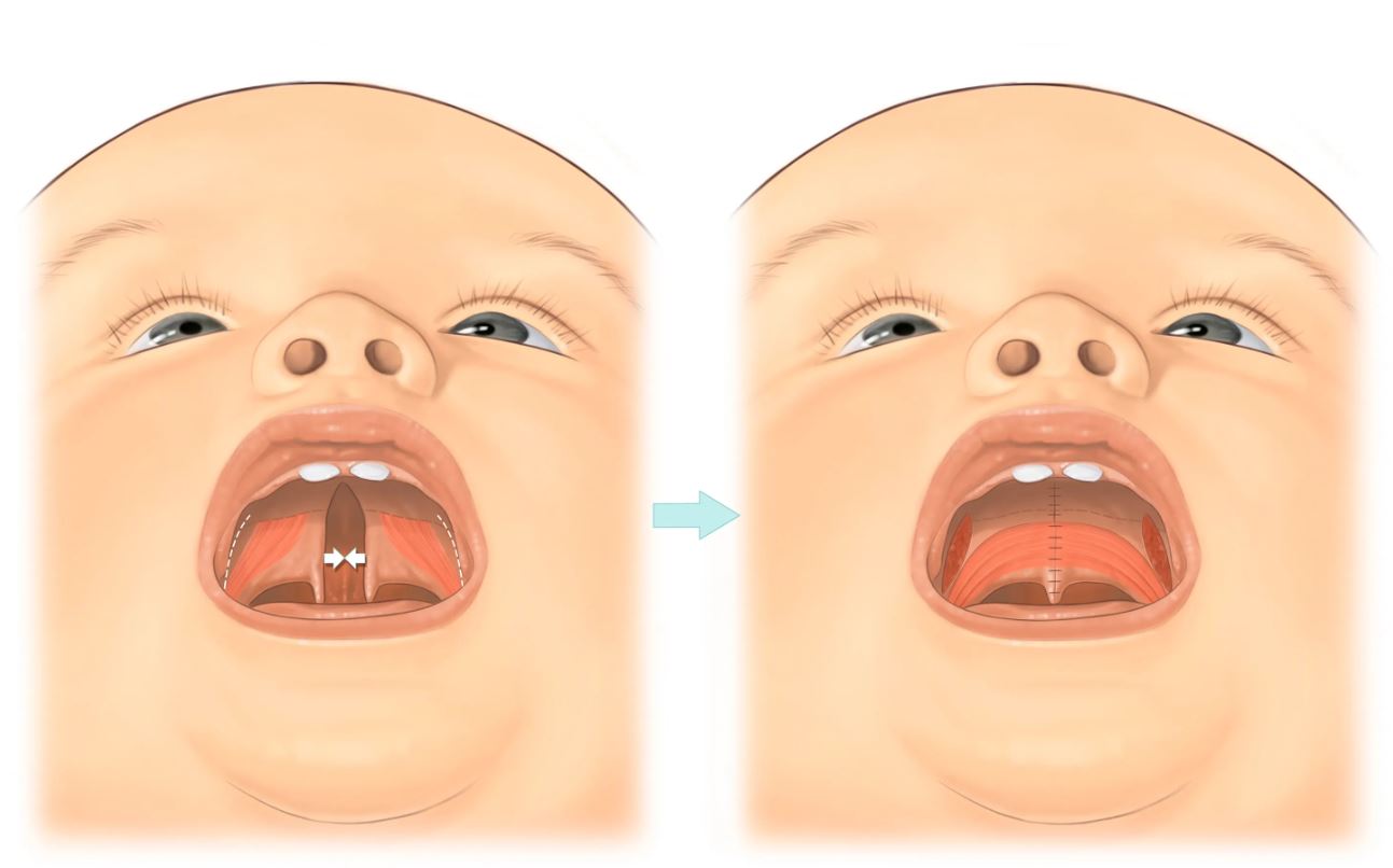 Расщелина неба – волчья пасть