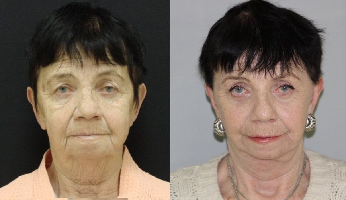 Спейслифтинг – до и после