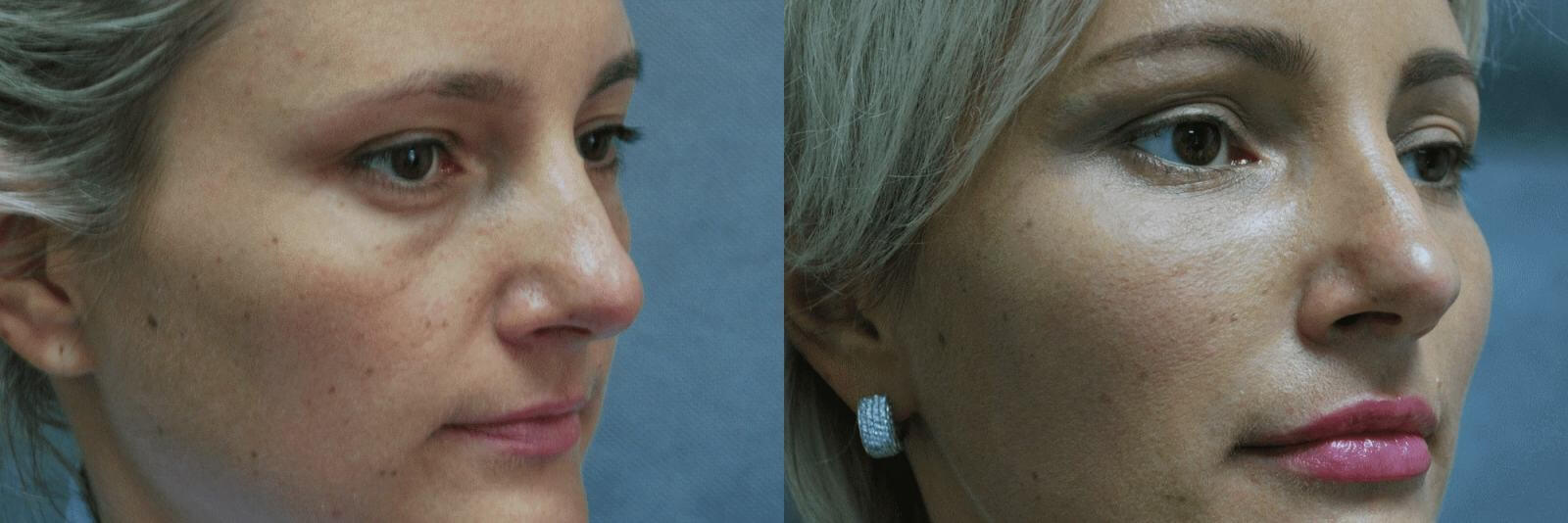 Липофилинг преображает внешность без заметных следов