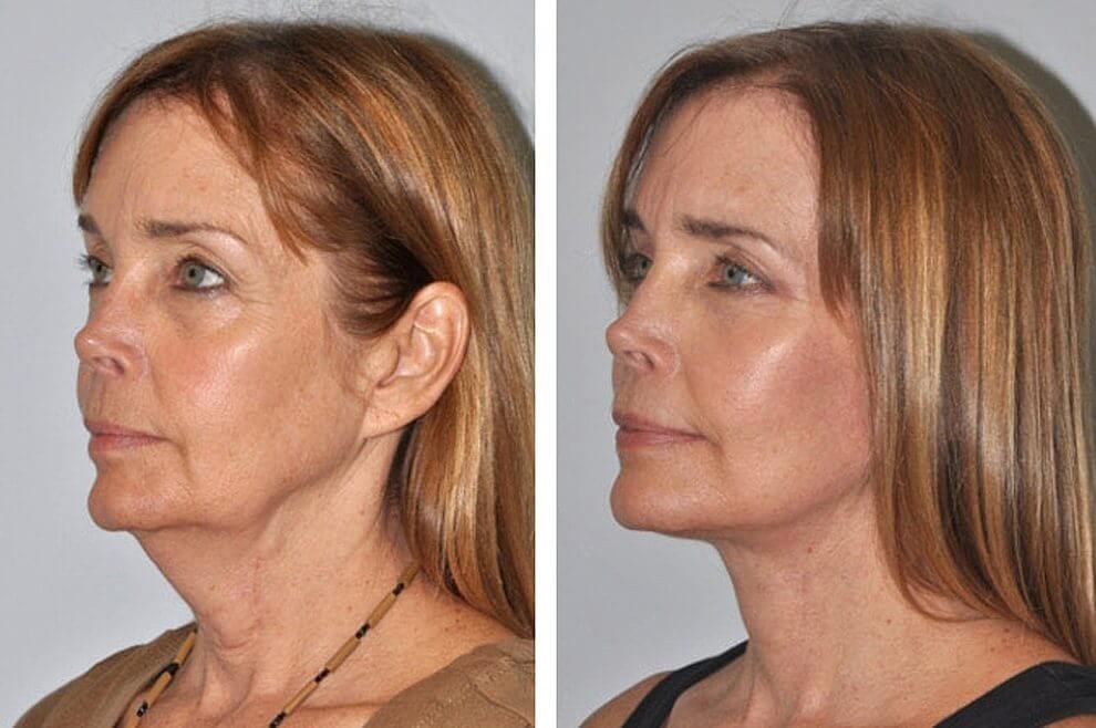 Эффективнее всего делать нитевой лифтинг сразу в нескольких зонах