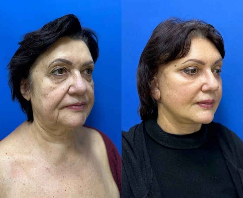 Для сильно выраженных возрастных изменений нет ничего лучше круговой подтяжки лица