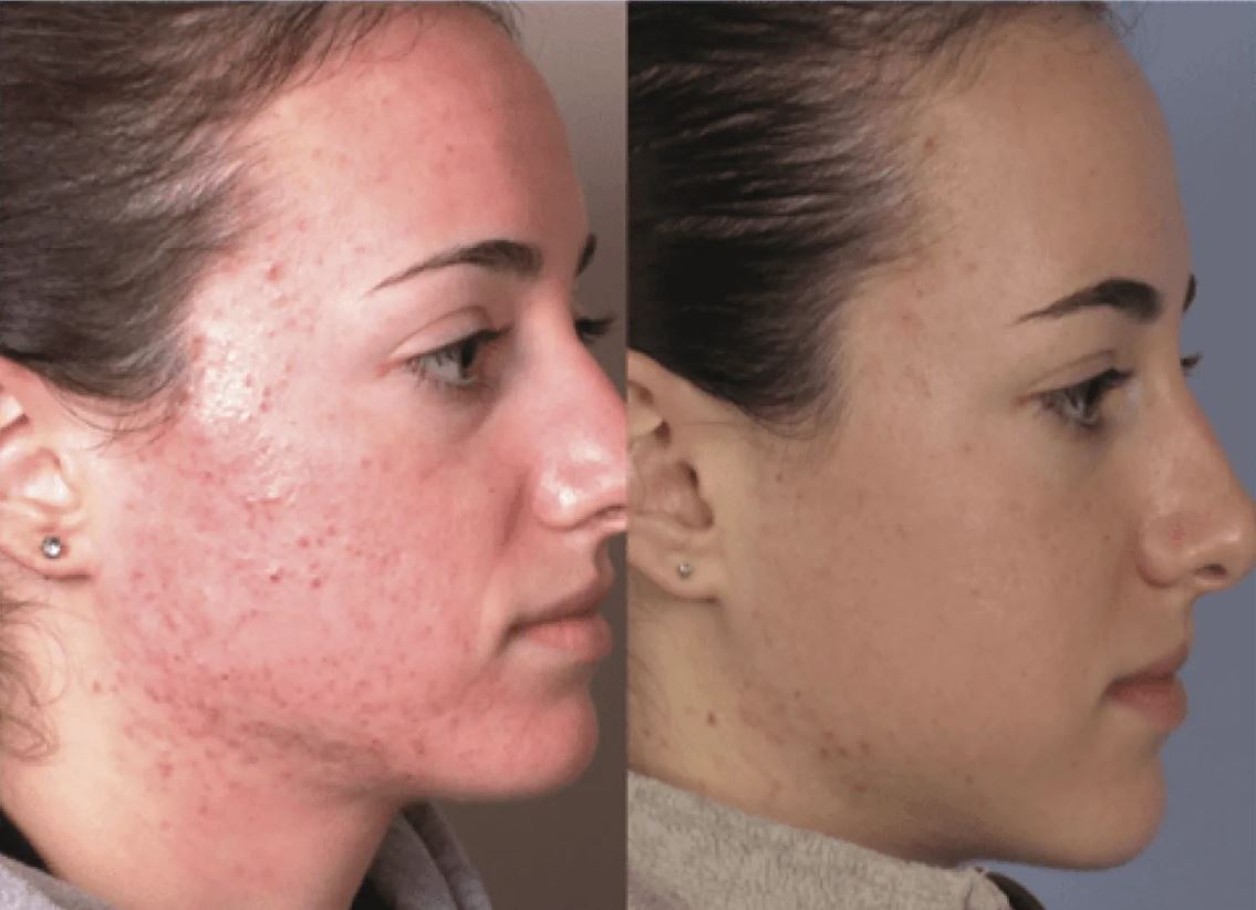 Микродермабразия дает отличные результаты. Но проявляются они только через пару недель