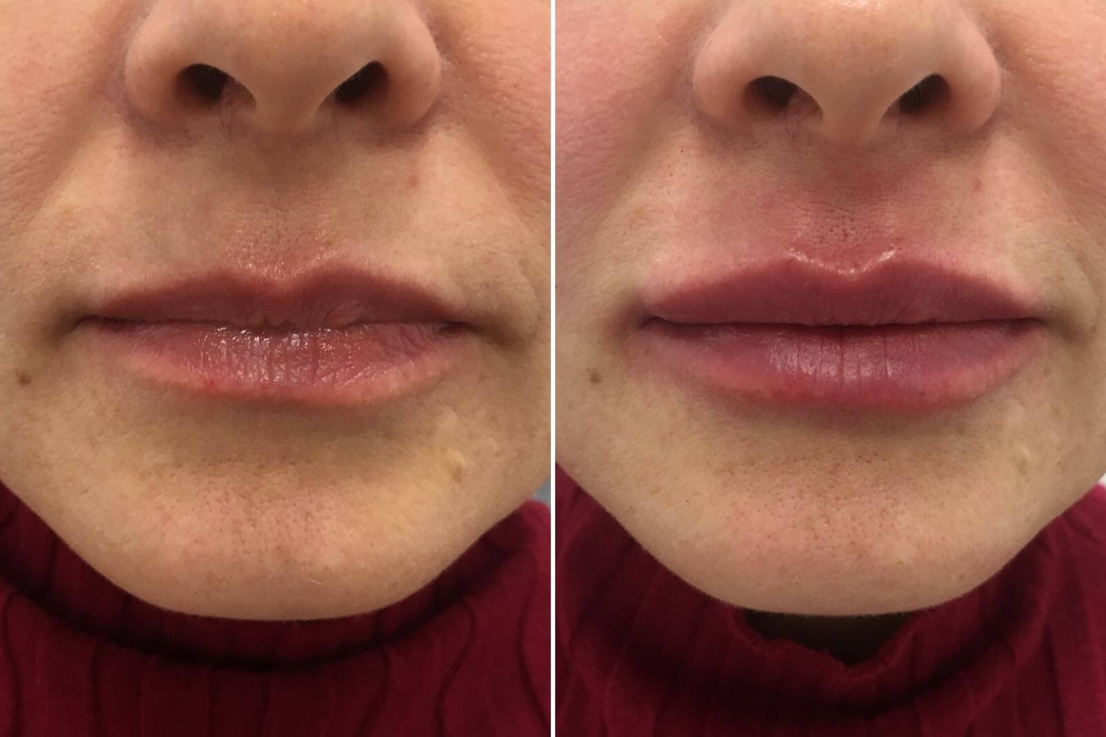 Несколько часов и даже суток губы после увеличения филлерами выглядят отечными, а кожа вокруг них краснеет