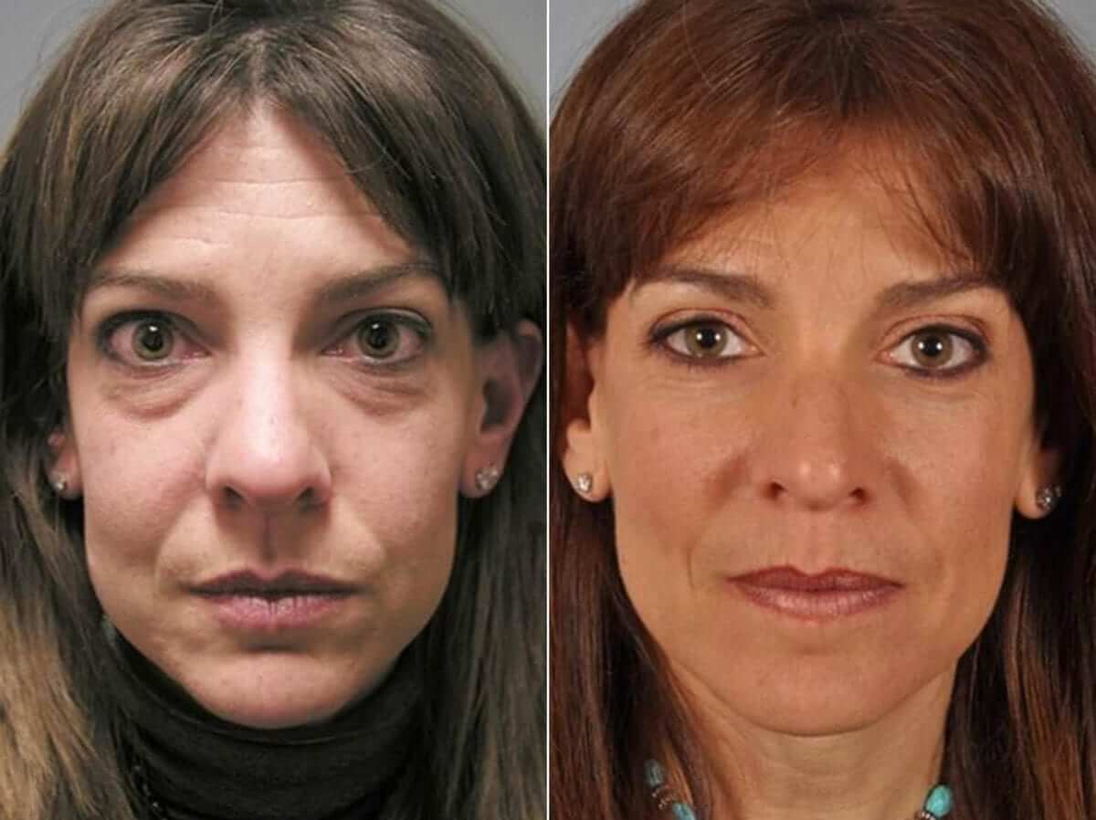 Каждый мужчина хочет видеть рядом с&nbsp;собой молодую и&nbsp;привлекательную женщину. Блефаропластика &ndash; отличный способ добиться желаемого