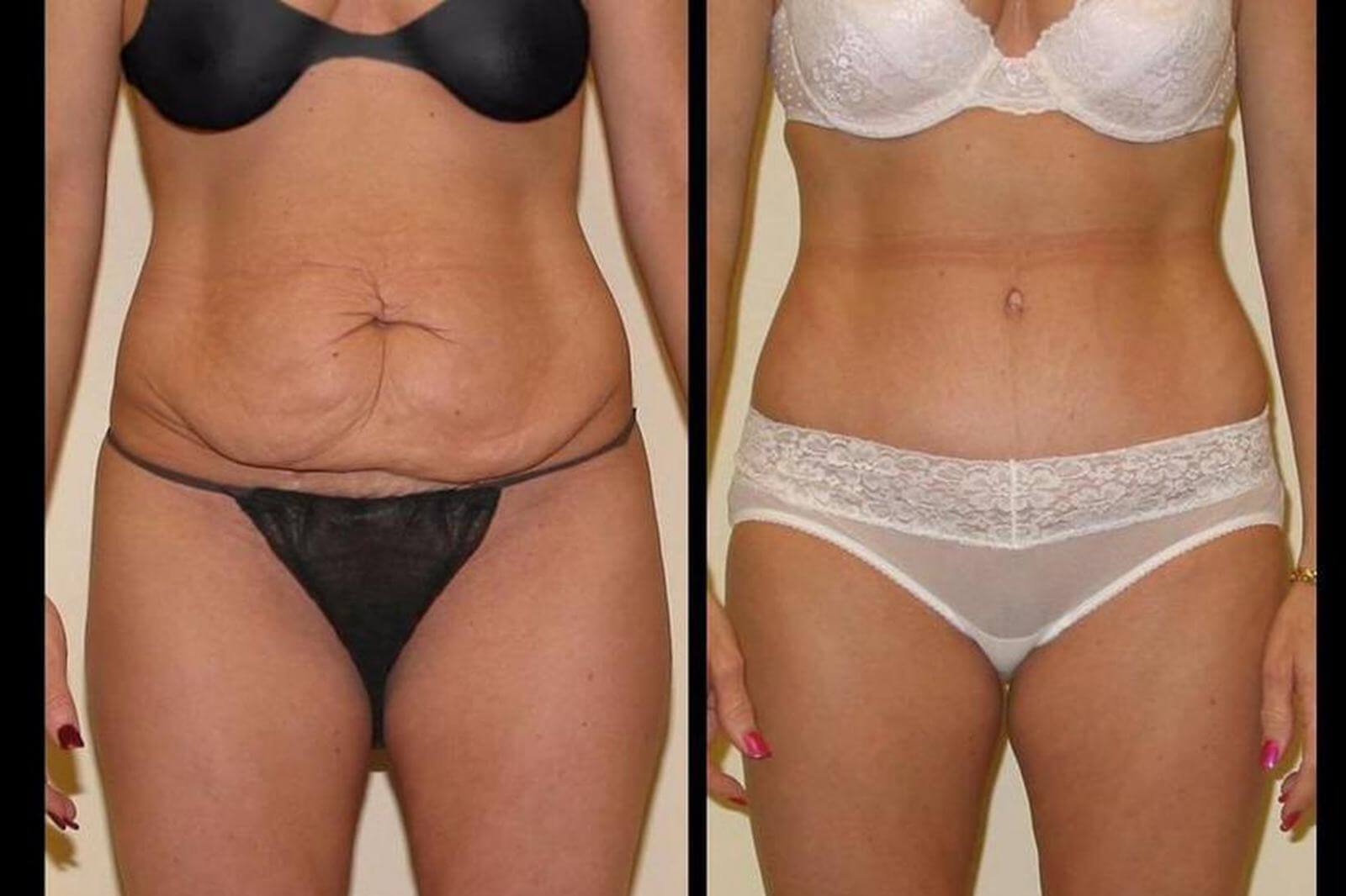 Абдоминопластика творит с&nbsp;фигурой настоящие чудеса 