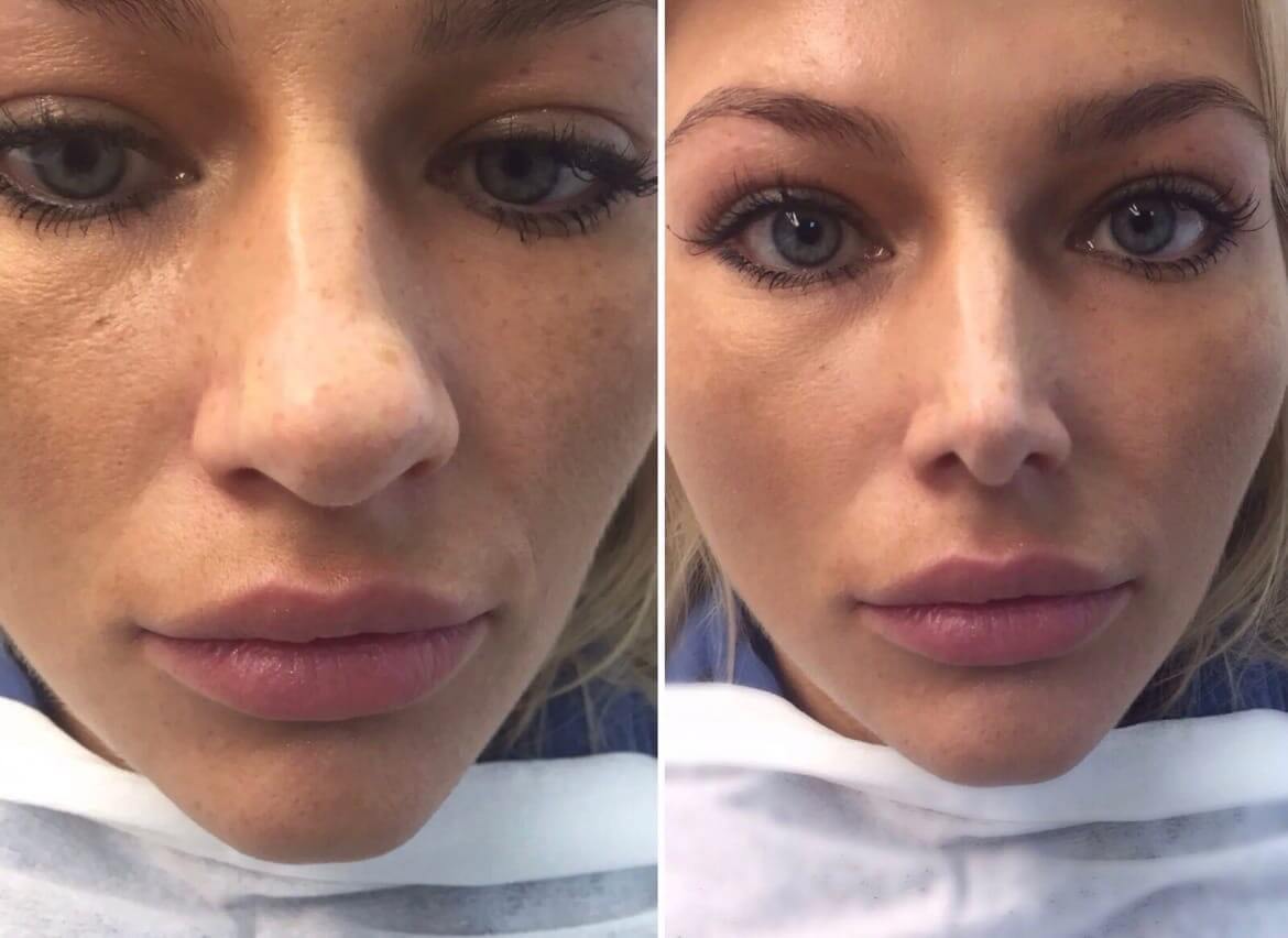 Пластика кончика носа делает лицо моложе и&nbsp;привлекательнее