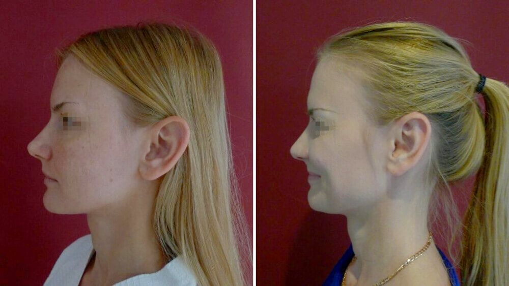 Когда нужно уменьшить размеры ушных раковин, без иссечения хряща не&nbsp;обойтись