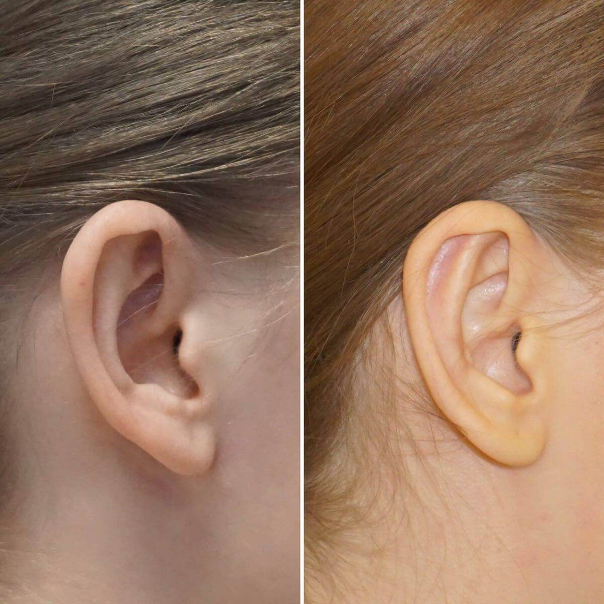 Небольшую лопоухость можно скорректировать без иссечения хрящевой ткани