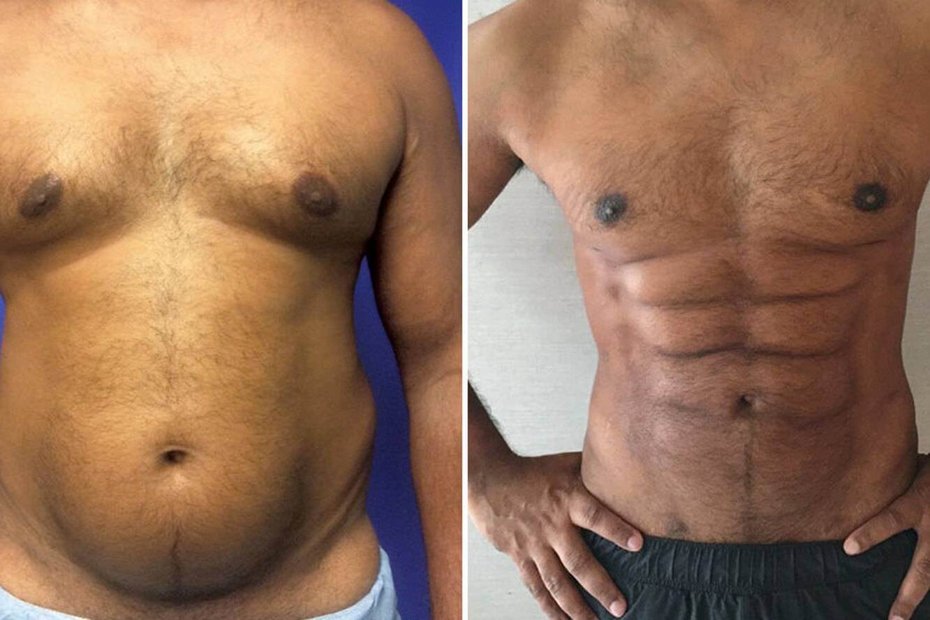 Импланты и липосакция могут сделать из любого мужчины культуриста 