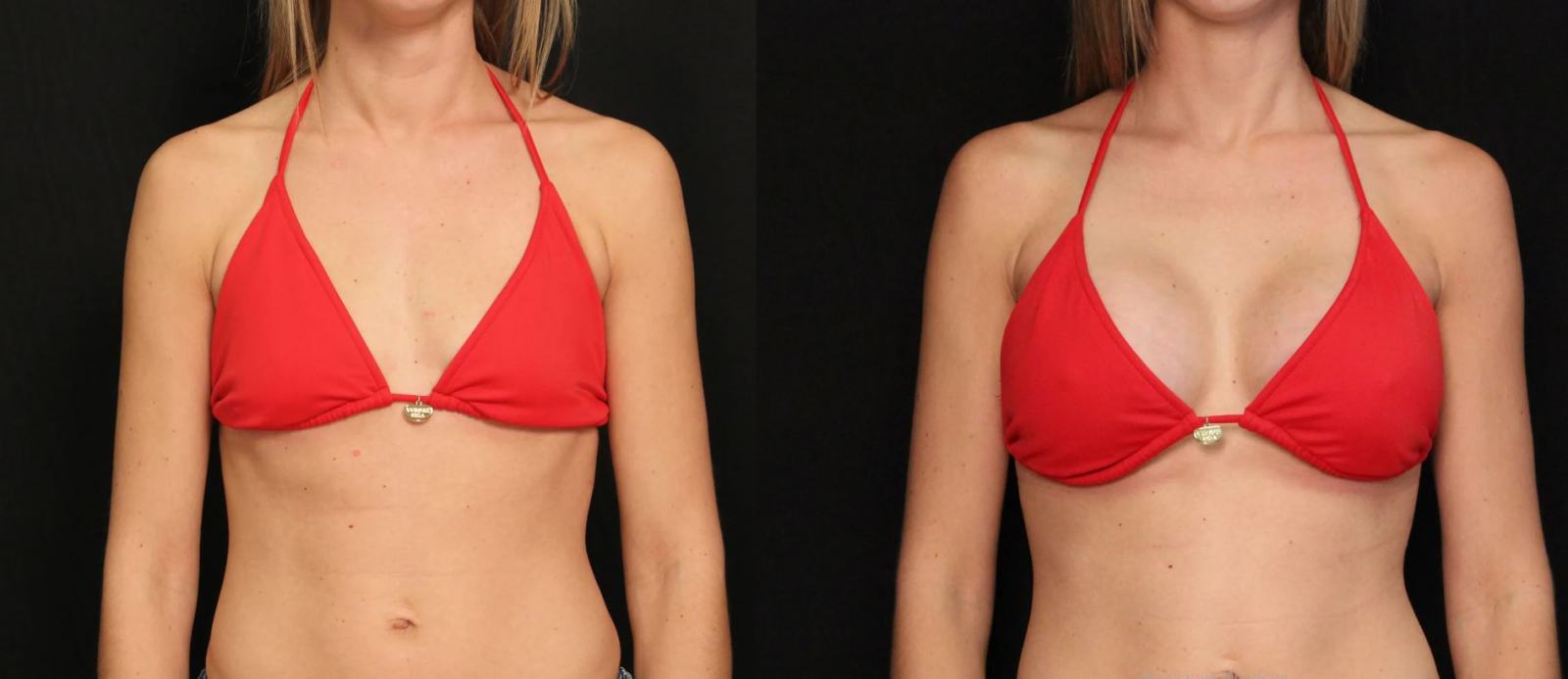 Цель большинства молодых пациенток – увеличение груди и коррекция ее формы