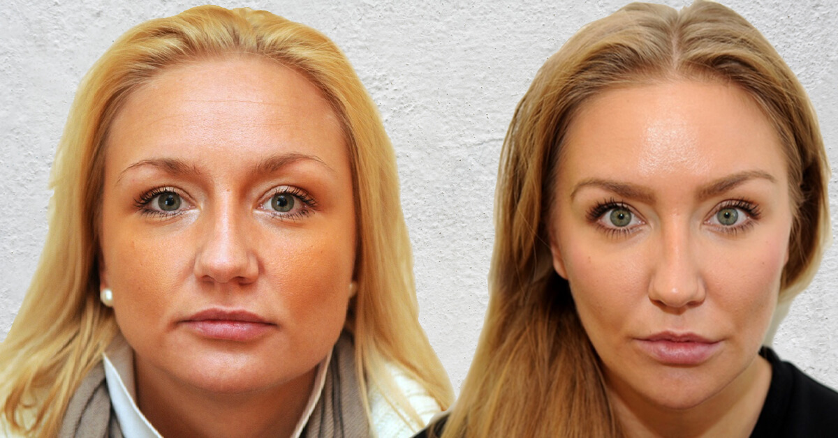 Просто устранив бруксизм, можно гармонизировать нижнюю треть лица