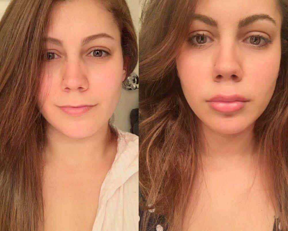 Инъекции гиалуроновой кислоты &ndash; самый простой способ увеличить губы