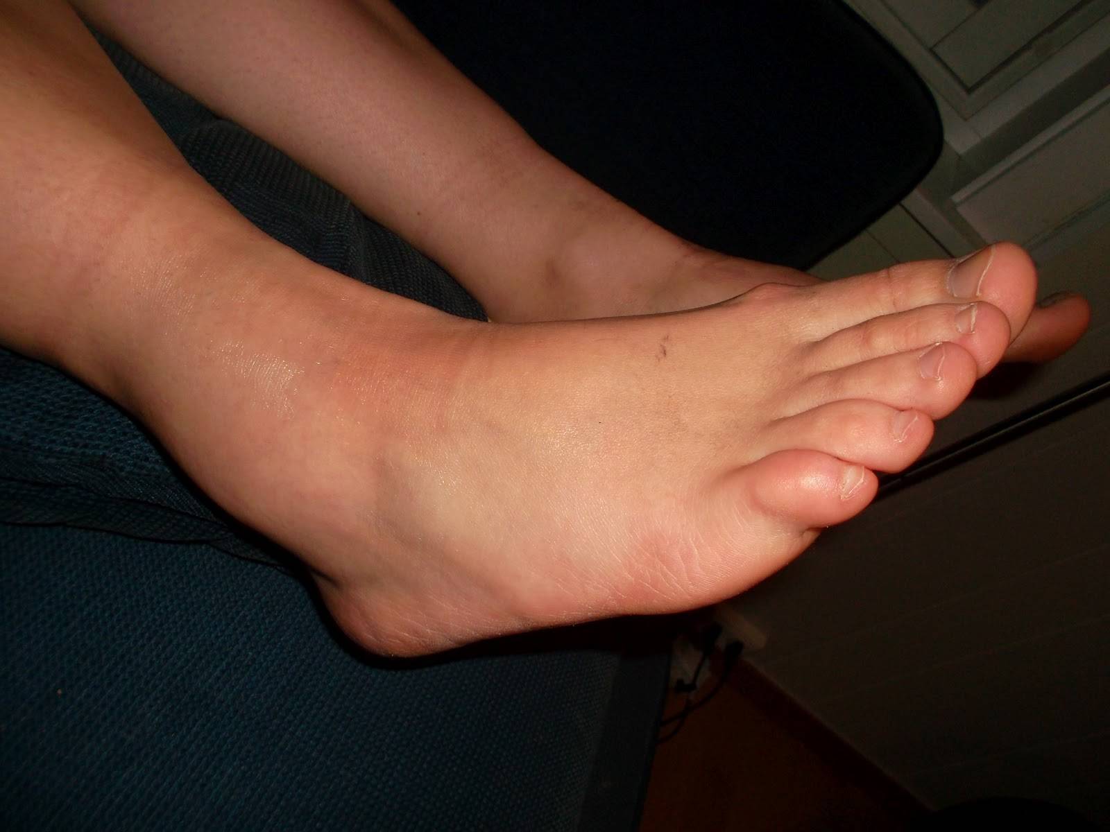 Опухшие голеностопные суставы – это не только некрасиво, но еще и больно