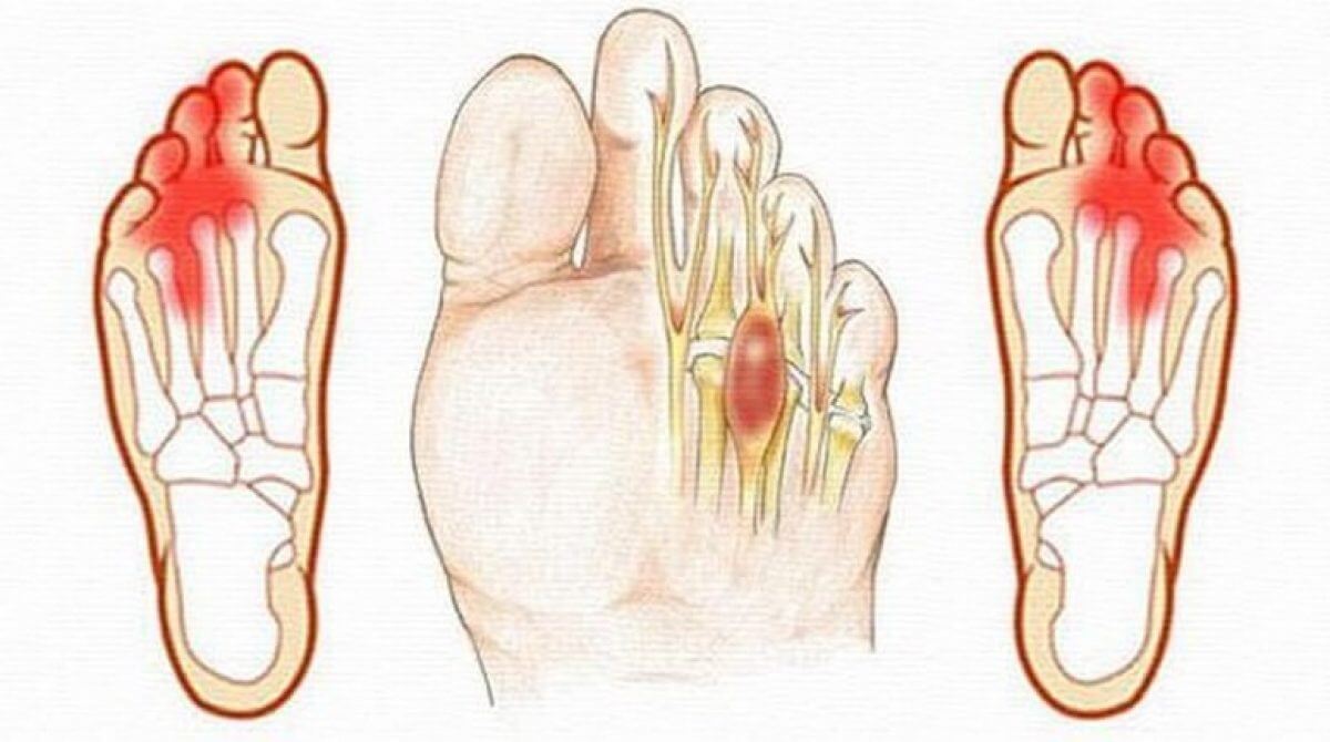 При невралгии Мортона стопа не деформируется, но походка страдает из-за постоянного дискомфорта