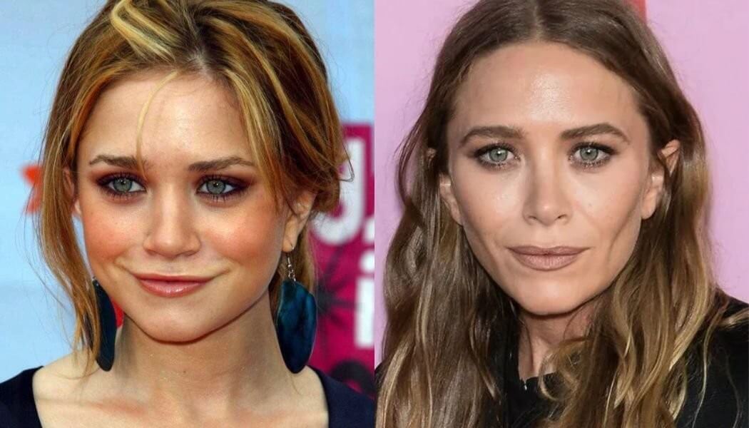 Мэри-Кейт Олсен – одна их тех, чью внешность испортило удаление комков Биша