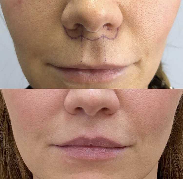 Булхорн стоит делать тогда, когда верхняя губа действительно слишком тонкая