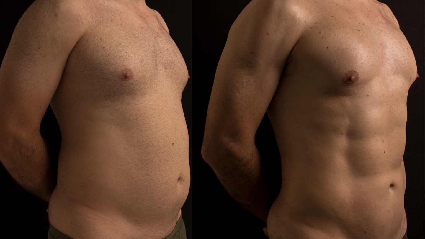 С помощью липосакции и&nbsp;липофилинга можно сделать тело рельефным