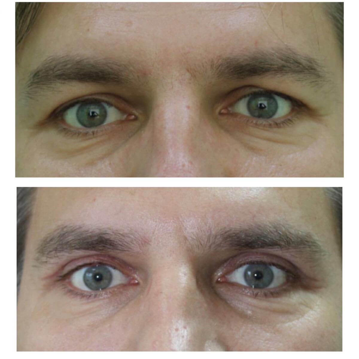 Пластика верхних век обеспечивает нормальное поле зрения и&nbsp;свежий внешний вид