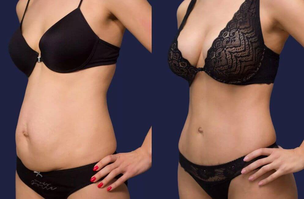 В 2023 году грудные импланты по-прежнему были популярны, но сейчас бюст стараются делать более естественным и пропорциональным 