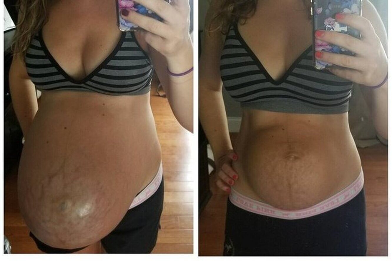 Сразу после родов живот всегда остается выпуклым, но&nbsp;в&nbsp;норме он должен со&nbsp;временем прийти в&nbsp;обычное состояние