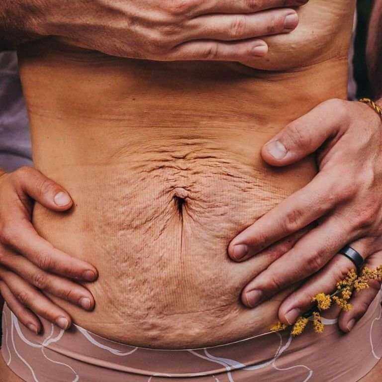 Нередко живот рожавшей женщины спустя месяцы после появления на&nbsp;свет ее ребенка остается в&nbsp;непривлекательном состоянии. Здесь на&nbsp;помощь и&nbsp;приходит пластика