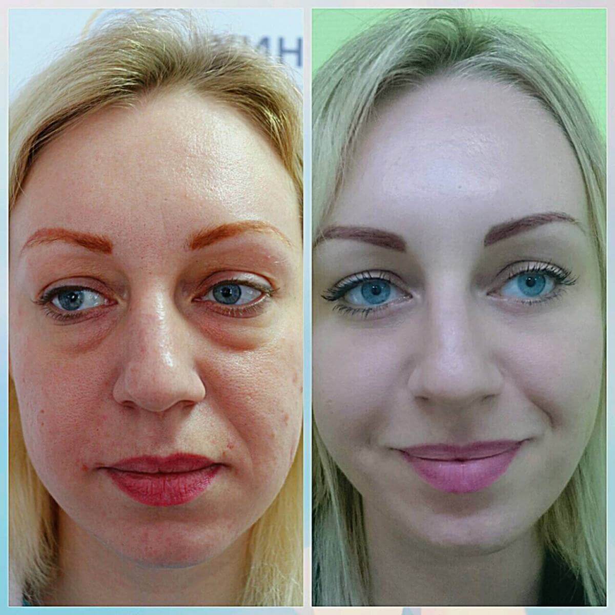 Если нет больших эстетических проблем, для&nbsp;видимого омоложения может хватить одной блефаропластики