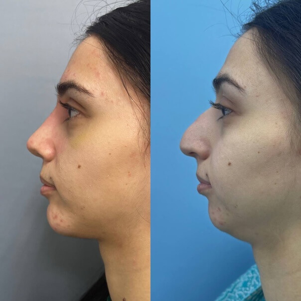 Профилопластика – результат комплексной операции