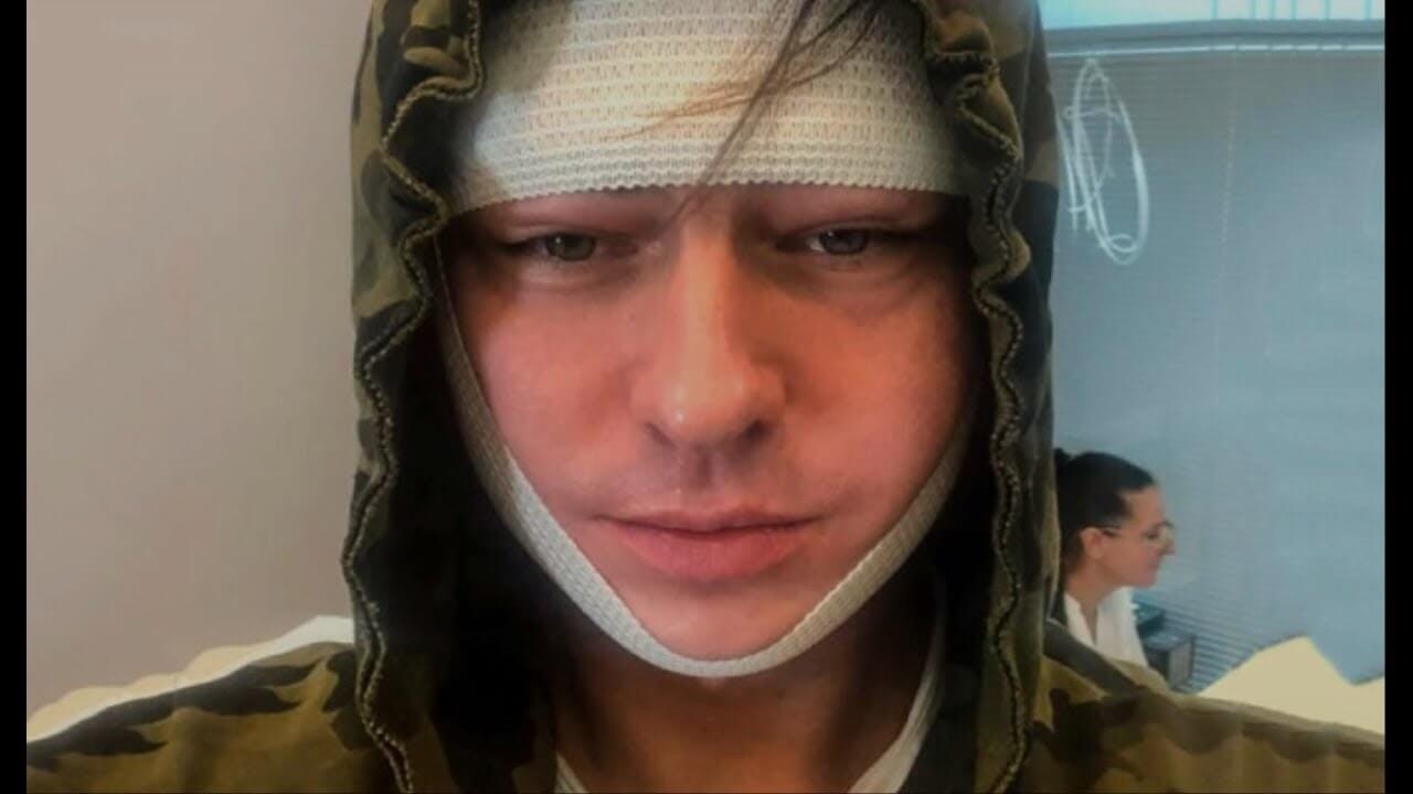 Шаляпин откровенно рассказывает фанатам о своих процедурах красоты и выкладывает фото в бинтах