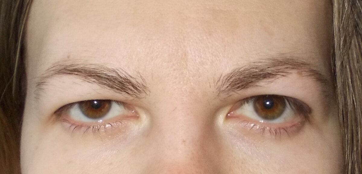 Нависшие веки могут быть и&nbsp;у молодых людей &ndash; это не&nbsp;возрастной дефект, а&nbsp;врожденная особенность внешности