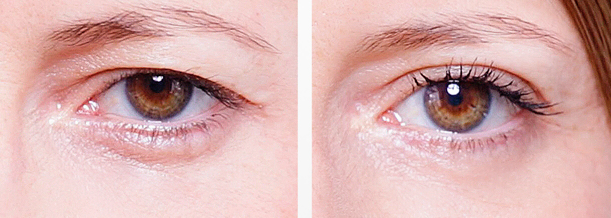 Блефаропластика позволяет добиться эффекта, которого не&nbsp;дадут самые дорогие кремы и&nbsp;косметические процедуры