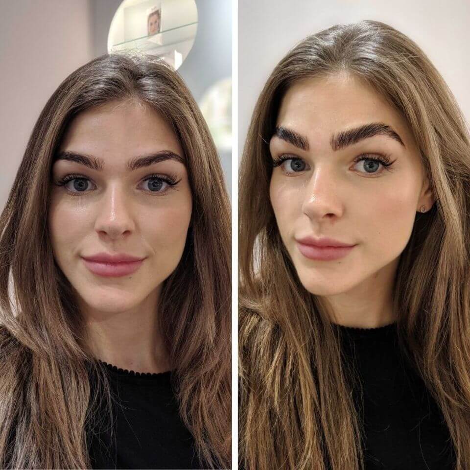 Подтяжка лба и&nbsp;бровей отлично открывает глаза 