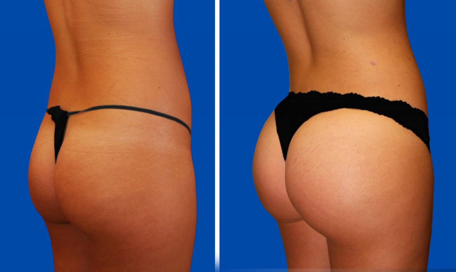 Пластика позволяет щеголять красивыми ягодицами не&nbsp;только в&nbsp;одежде, но&nbsp;и&nbsp;без нее