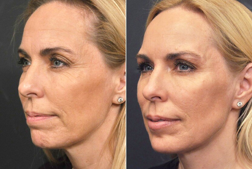 До и после векторного лифтинга с применением препарата Радиесс