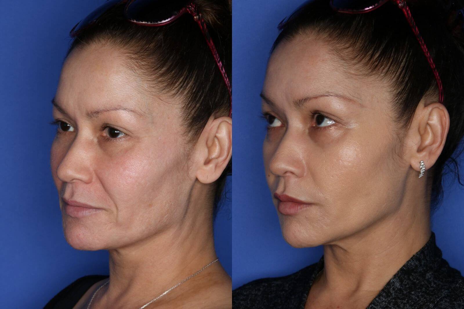 Радиесс не только разглаживает морщины, но и корректирует овал лица