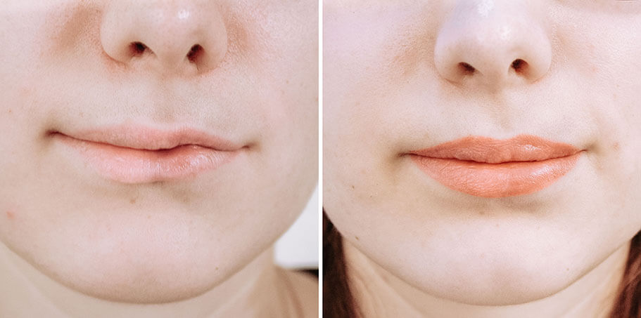 Реконструктивная хейлопластика часто позволяет полностью восстановить внешний вид и функциональные возможности губ 