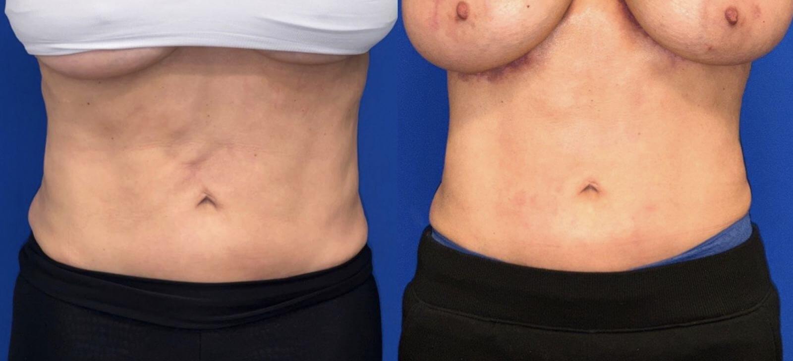 Обратная абдоминопластика – до и после операции