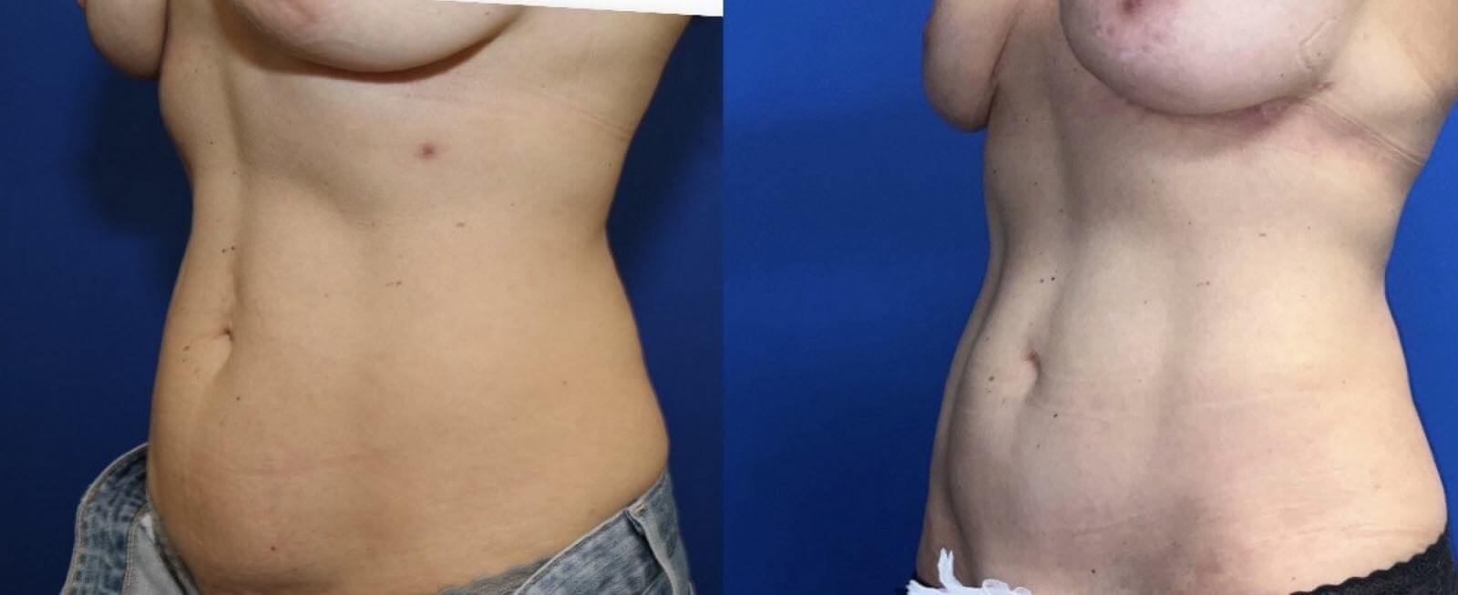 Обратная пластика живота не такая травматичная, как классическая, шрамы после нее легко скрыть даже под купальником-бикини